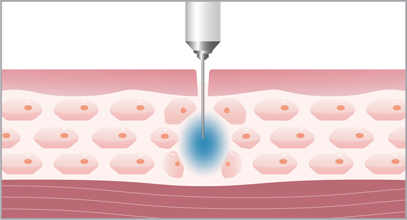 Syna_Injektion mit der Nadel
